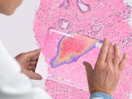 HLTH21: Roche, Ibex Medical Partner to Develop AI-Powered Digital Pathology Apps